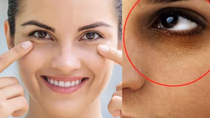 Dark Circles Under Eyes Causes Treatment and Prevention