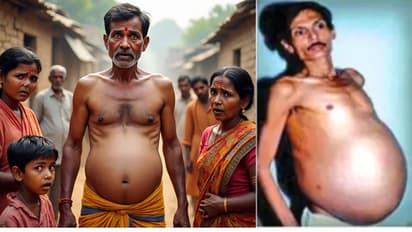 Astonishing Medical Case Man Carries Twin for 36 Years in Nagpur | Fetus in Fetu Miracle