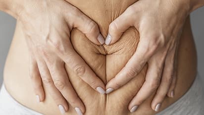 3-homemade-scrubs-that-can-remove-stretch-marks