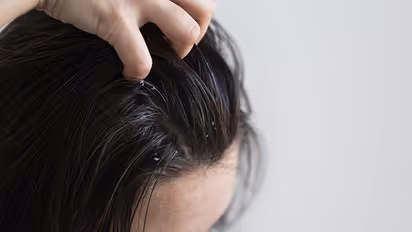 Jawed-Habib-diy-tips-for-severe-dandruff