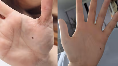 Right-or-left-hand-mole-meaning