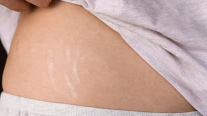 Stretch marks