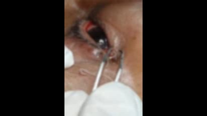 worm inside eye