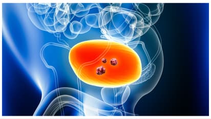 bladder cancer