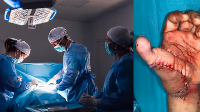 Bright Side Stories: Doctors reconstruct thumb from amputated leg 