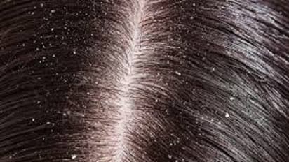 ಕೇಶವನ್ನು ಕೇರ್ಫುಲ್ ಆಗಿ ಕಾಪಾಡಿಕೊಳ್ಳೋದು ಹೇಗೆ?