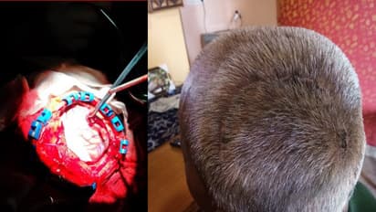 ಆಪರೇಷನ್ ಟೈಮಲ್ಲಿ ತಲೆ ಚಿಪ್ಪು ಮಿಸ್ ಮಾಡಿದ ವೈದ್ಯ