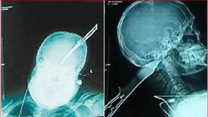 ತಮಾಷೆಯಲ್ಲ: ತಲೆಗೆ ಚಾಕು ಹೊಕ್ಕಿದ್ದರೂ ಬೈಕ್ ಓಡಿಸಿ ಬದುಕುಳಿದ ಭೂಪ!