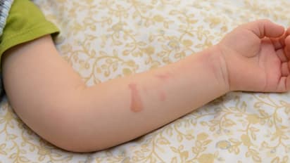 ఎంతైనా సవతి తల్లి సవతి తల్లే... నిద్రలో పక్క తడుపుతోందని చిన్నారికి వాతలు