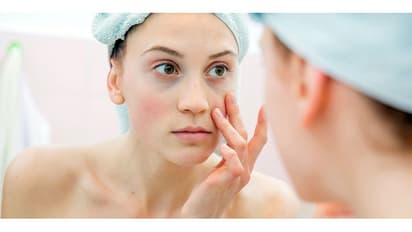 Say goodbye to those dark circles with these home remedies