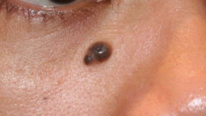 உங்கள் உடல் மட்டுமல்ல....முகத்திலும் மருவா..? இதோ ஒரே ஒரு தீர்வு..!