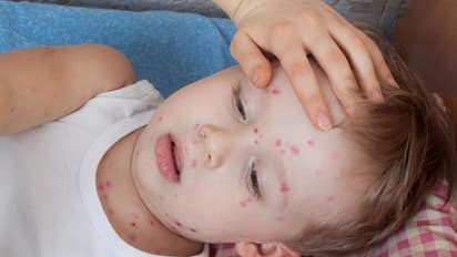 75 நாட்களில் 6,744 பேருக்கு அம்மை நோய் பாதிப்பு.. கேரள சுகாதாரத்துறை அதிர்ச்சி தகவல்..