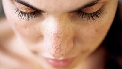 முகத்தில் அசிங்கமா தோன்றும் கரும்புள்ளிக்கு சூப்பர் தீர்வு..!