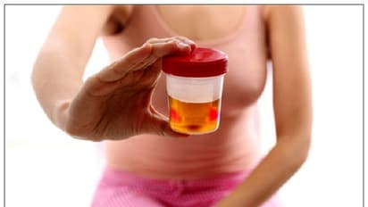 Blood in Urine: ಮೂತ್ರದ ಬಣ್ಣ ಬದಲಾಗೋದ್ಯಾಕೆ? ಎಚ್ಚರಿಕೆ ವಹಿಸಿ