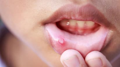 Mouth ulcers: வாய்ப் புண்ணால் அடிக்கடி அவஸ்தையா? இதோ இருக்கு சில பாட்டி வைத்தியங்கள்!