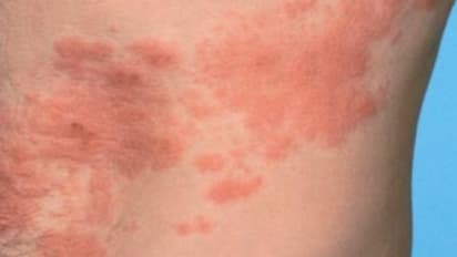 ಸರ್ಪಸುತ್ತು ಬರಲು ಕಾರಣ ನಾಗದೋಷವಲ್ಲ ಈ ವೈರಸ್!