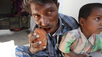 20 വർഷമായി ഈ യുവാവ് കഴിക്കുന്നത് കല്ല്,ഇഷ്ടിക,മണ്ണ്