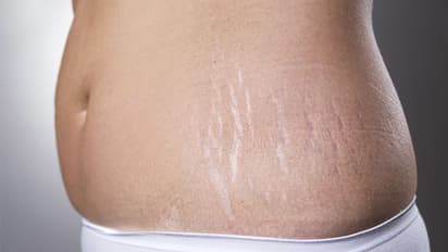 പ്രസവശേഷമുളള സ്‌ട്രെച്ച്മാര്‍ക്‌സിന് പരിഹാരമുണ്ട്