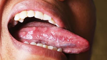 ನಿಮ್ಮ ಆರೋಗ್ಯ ಹೇಗಿದೆ ತಿಳಿದುಕೊಳ್ಳಬೇಕೇ? ಹಾಗಾದ್ರೆ ನಾಲಗೆ ಪರೀಕ್ಷಿಸಿ!