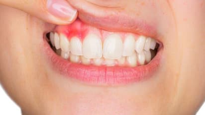 മോണയിൽ നിന്ന് രക്തം വരാറുണ്ടോ?