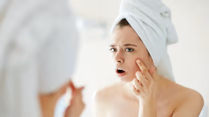 Foods that you should avoid to keep your skin acne-free