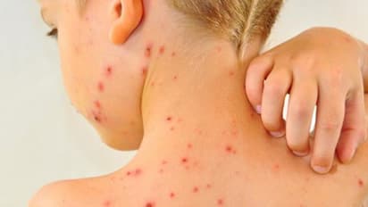 ചിക്കൻ പോക്സ് സൂക്ഷിക്കണേ; ശ്രദ്ധിക്കേണ്ട കാര്യങ്ങൾ