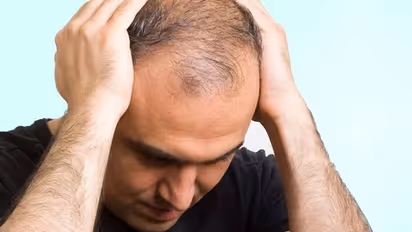 தலையில் வழுக்கை விழுவதை தடுக்கும் தயிர்! ஆண்களே ஒரு நிமிசம் இதை படிங்க!