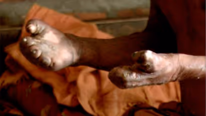 ಚಿಕ್ಕಬಳ್ಳಾಪುರದಲ್ಲಿ 66 ಕುಷ್ಠ ರೋಗ ಪ್ರಕರಣ ಪತ್ತೆ