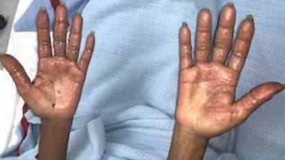 മുടി ഡൈ ചെയ്യുന്നതിനിടെ ഗുരുതരമായി പൊള്ളലേറ്റ യുവതി ആശുപത്രിയില്; മുന്നറിയിപ്പുമായി ഡോക്ടര്മാര്