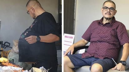 കുടവയർ ആണെന്ന് ആദ്യം കരുതി; പക്ഷേ, ഡോക്ടർമാർ വയർ പരിശോധിച്ചപ്പോൾ കണ്ടെത്തിയത് 34 കി.ഗ്രാം ഭാരമുളള മുഴ