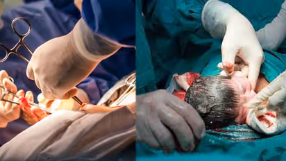 Cesarean baby: சிசேரியன் மூலம் குழந்தை பெற்றவர்களா ..? உங்களுக்கு இந்த 5 விஷயங்களில் அதிக கவனம் தேவை!