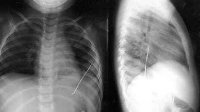 അബദ്ധത്തിൽ വിഴുങ്ങിയ പിൻ ശ്വാസകോശത്തിൽ കുടുങ്ങി; ആറാം നാൾ പുറത്തെടുത്തു