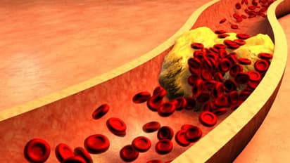 High Cholesterol: பெண்களுக்கு இந்த பகுதியில் அதிக கொழுப்பு ஆபத்து ...? நிபுணர்கள் சொல்லும் அதிர்ச்சி தகவல்..