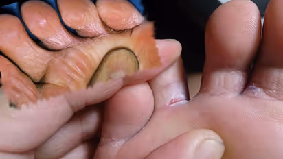 ಮಳೆಗಾಲದಲ್ಲಿ ಕಾಡೋ ಕಾಲ್ಬೆರಳಿನ ಫಂಗಸ್ ಸಮಸ್ಯೆ: ಮನೆಯಲ್ಲಿದೆ ಮದ್ದು!