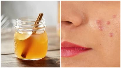 முகப்பருக்கு ஒரே வாரத்தில் தீர்வு..! பருவும் வராது வடுவும் தெரியாது..!