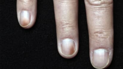 നഖത്തിലെ ബ്രൗണ് നിറം; ശ്രദ്ധിക്കുക വൃക്ക രോഗത്തെ