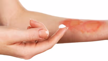 പൊള്ളലേറ്റാൽ ചെയ്യേണ്ടതും ചെയ്യാൻ പാടില്ലാത്തതും