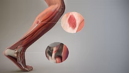 Platelet-rich Plasma Therapy: Here is how tennis, golf stars recover from injuries