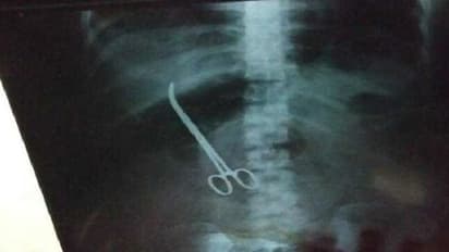 ಶಸ್ತ್ರಚಿಕಿತ್ಸೆ ವೇಳೆ ಹೊಟ್ಟೆಯಲ್ಲೇ ಎರಡು ಕತ್ತರಿ ಬಿಟ್ಟ ವೈದ್ಯರು!