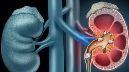 কিডনিতে স্টোন? এই ৭টি ঘরোয়া উপায়ে সারিয়ে ফেলুন সমস্যা