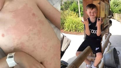 തലവേദന വന്നു, ശരീരം ചുവന്ന് തടിച്ചു, ഛർദ്ദിച്ചു, ബോധം പോയി; പരിശോധന ഫലം കണ്ട് രക്ഷിതാക്കൾ ഞെട്ടി...