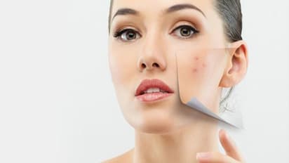 Black spot: முகத்தை வெளியே காட்ட சங்கடமா..? கரும்புள்ளிகளை நீக்க...இதைவிட சூப்பர் டிப்ஸ் கிடைக்காது...