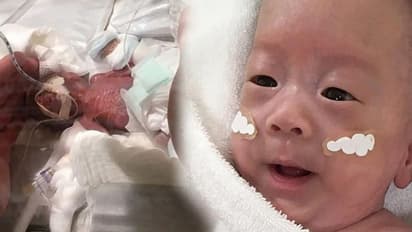 ವಿಶ್ವದ ಅತ್ಯಂತ ಚಿಕ್ಕ ಮಗುವಿದು: 20 ವಾರಕ್ಕೇ ಜನನ, ತೂಕ ಕೇವಲ 268 ಗ್ರಾಂ!