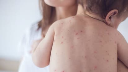 'ചിക്കന്പോക്സ്' എപ്പോഴെല്ലാം പകരും? രോഗിക്ക് കഴിക്കാനെന്തെല്ലാം നല്കാം? അറിയേണ്ടത്...