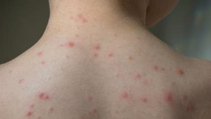 ചിക്കൻപോക്സ്; ലക്ഷണങ്ങളും ശ്രദ്ധിക്കേണ്ട കാര്യങ്ങളും