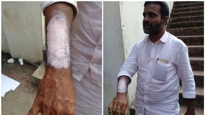 കോഴിക്കോട് ജെഡിഎസ് നേതാവിന് സൂര്യാഘാതമേറ്റു