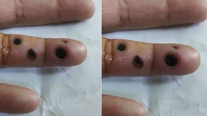 അരിമ്പാറ ഉരുക്കാന്‍ മരുന്നൊഴിച്ചു; അരിമ്പാറയ്‌ക്കൊപ്പം വിരലും ഉരുകി!