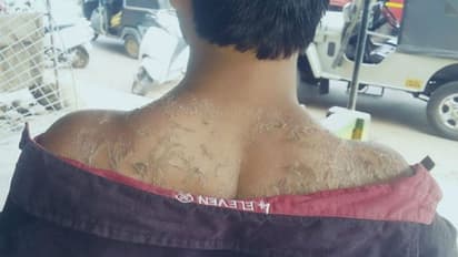 'ഒന്ന് തൊടാന്‍ പോലും പറ്റാത്ത വിധം പൊള്ളിപ്പോയി'; സൂര്യാഘാതമേറ്റയാളുടെ അനുഭവക്കുറിപ്പ്