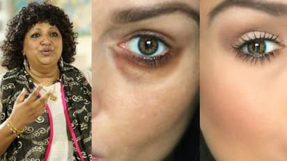 കണ്ണിന് ചുറ്റും കറുപ്പ് നിറമുണ്ടോ? പരിഹാരം അംബികാപിളള പറയും...