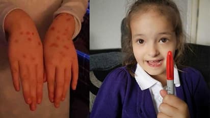 പരീക്ഷാപ്പേടി: ചിക്കന്പോക്സാണെന്ന് തെറ്റിദ്ധരിപ്പിക്കാന് ഉപയോഗിച്ചത് പെര്മനന്റ് മാര്ക്കര്